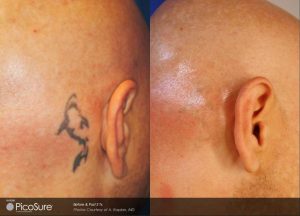 Oops Laser Tattoo Removal  Face tattoos Thoughts Before and after 5  The laser sees colors differently often producing different results for  black lines and colors Both of these tattoos have had